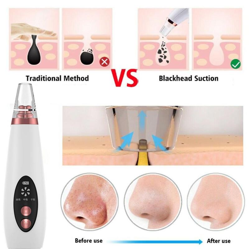 Blackhead Remover for Pore Cleansing – Effective Skin Care Tool