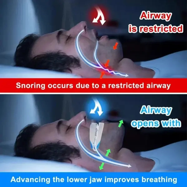 Adjustable Snoring Mouth Guard Clear Silicone Stop Snoring Device