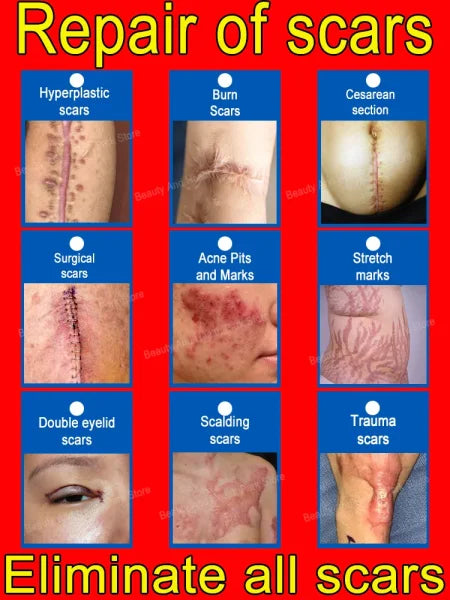 Remove various scars, stretch marks, surgical scars - Himpall