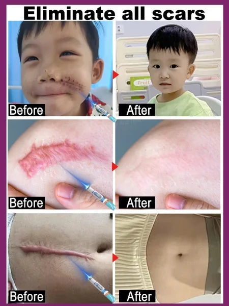 Remove various scars, stretch marks, surgical scars - Himpall
