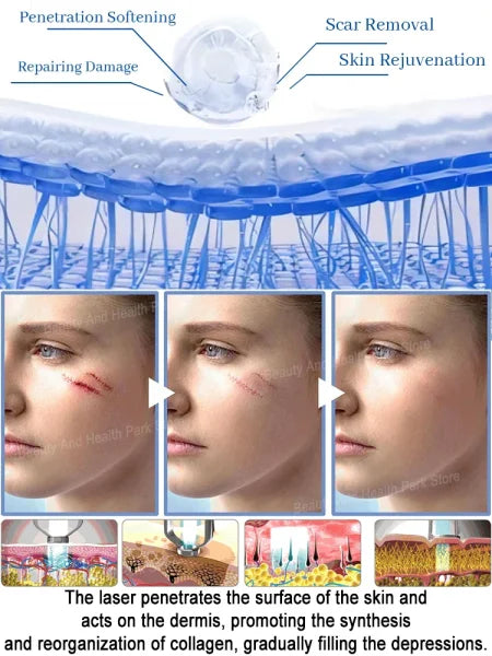 Remove various scars, stretch marks, surgical scars - Himpall