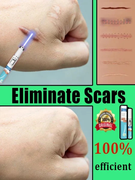 Remove various scars, stretch marks, surgical scars - Himpall